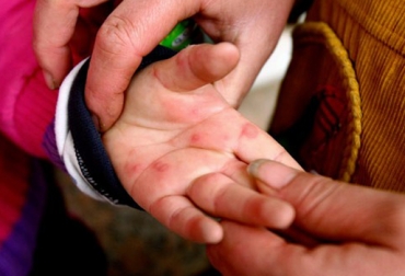 Los efectos de la enfermedad también son transmitidos al ser humano causando lesiones dolorosas en manos y labios. Foto: primeraedicionweb.com.ar Estomatitis